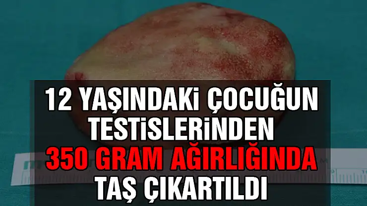 12 yaşındaki çocuğun testislerinden 350 gram ağırlığında taş çıkartıldı
