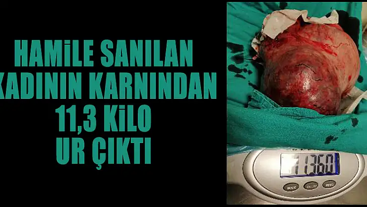Hamile sanılan kadının karnından 11,3 kilo ur çıktı