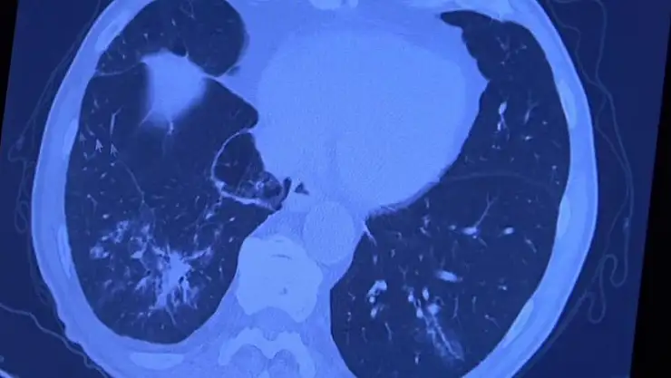 2. doz Covid-19 aşısı olan kişilerin gerçek yaşam sonuçları