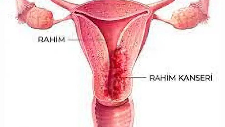 Rahim ağzı kanserinde erken teşhis hayat kurtarıyor