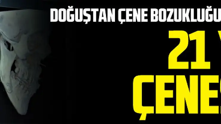 Doğuştan çene bozukluğu olan hastaya estetik çene: 21 yıl sonra çenesi düzeldi