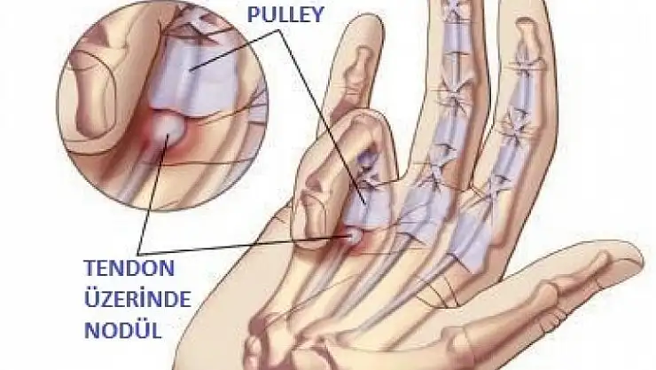 Tetik parmak hastalığı ve tedavisi