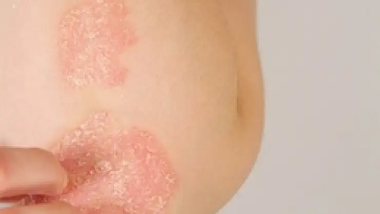 Prof. Dr. Özden'den sedef hastalarına müjde: 'Artık tedavisi var'