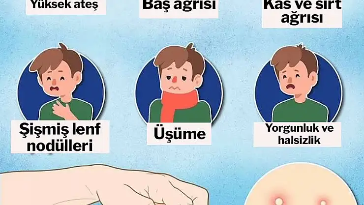 Maymun çiçeği salgınında korkutan uyarı: Semptomları değişiyor