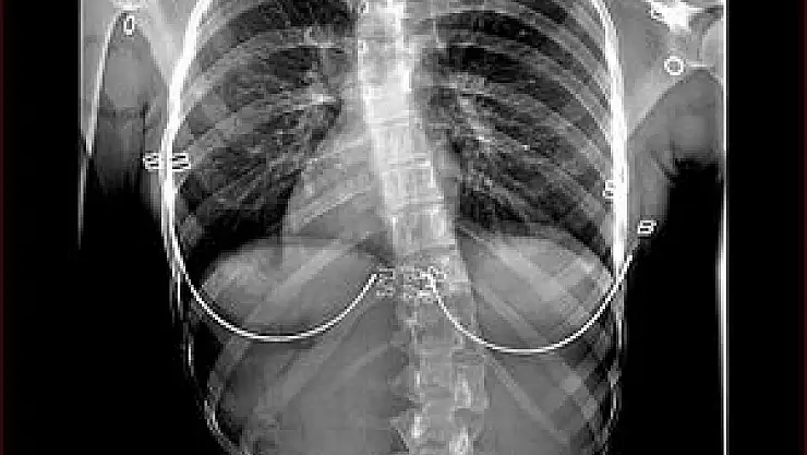 'Çocuklarda skolyoz tedavisi için en uygun zaman yaz tatili'