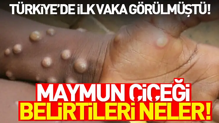 Maymun Çiçeği nedir? Maymun Çiceği belirtileri neler!