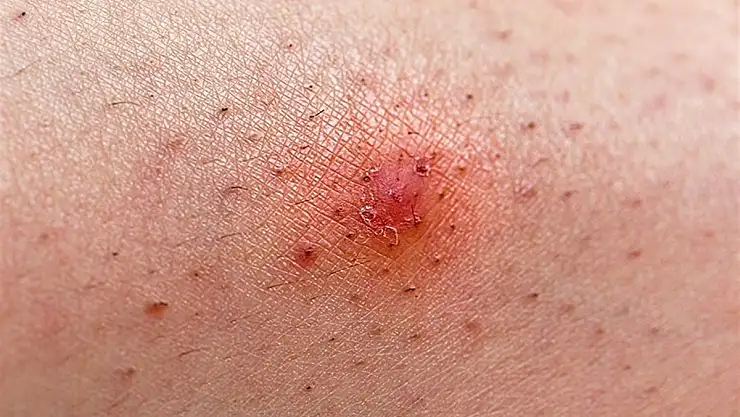 Kıl dönmesi ve tedavisi