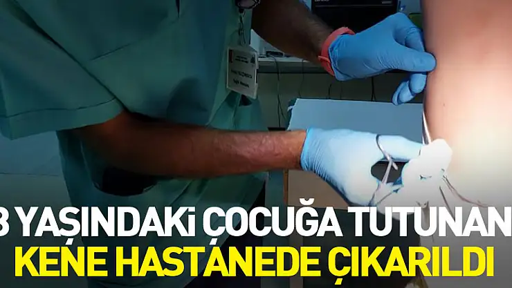 Samsun'da 8 yaşındaki çocuğa tutunan kene hastanede çıkarıldı