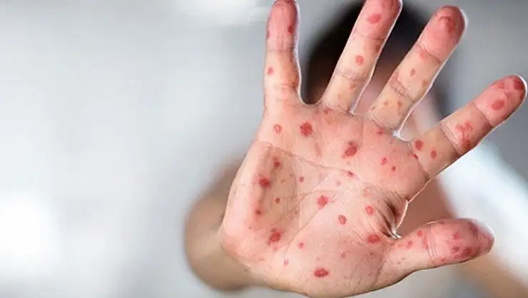 Uzmanı uyardı: Maymun çiçeği vakalarında artış bekleniyor