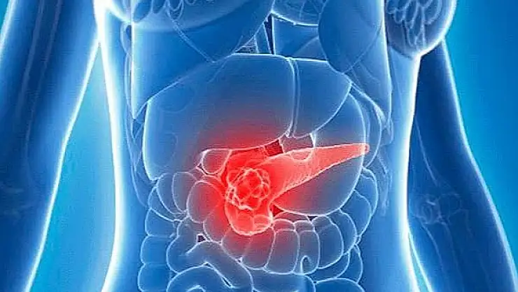 İşlenmiş gıdalar, alkol ve sigara 'pankreas kanseri' yapıyor