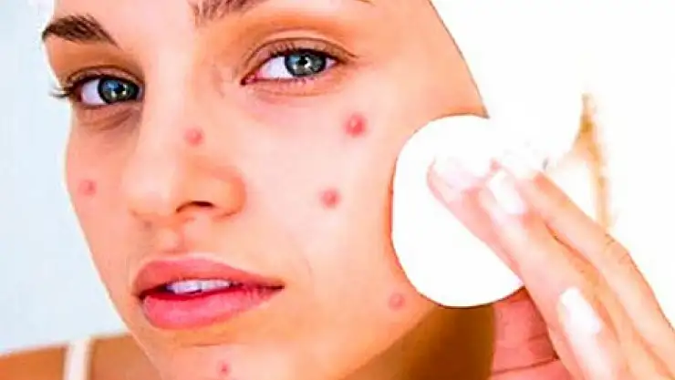 Doç. Dr. Pelin Üstüner, 'Skara dönüşen aknenin tedavisi yok'