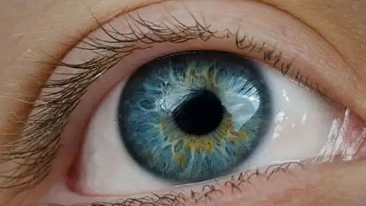 'Körlük nedenleri arasında ilk sırada, dünyada tek tedavisi ameliyat'