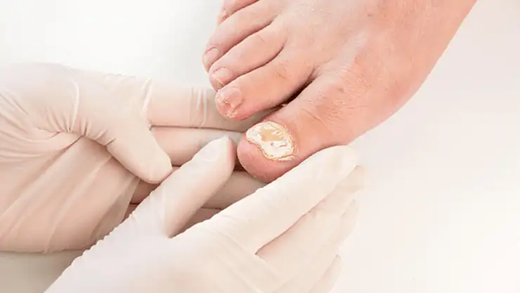 Tırnak Mantarı Tedavisi Farklı Yöntemlerle Uygulanabilir