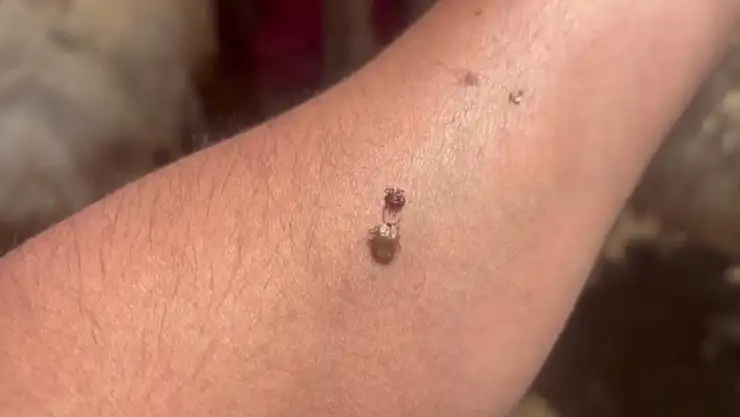 Uzmanlardan peş peşe uyarılar geliyor : Kene asla kendiniz tarafından çıkarılmamalı