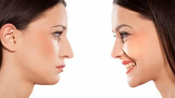 Yüz Şekillendirmede Çene Hattının Önemi Nedir?