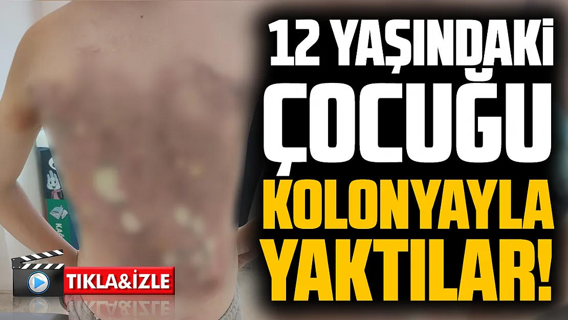 Arnavutköy'de akran zorbalığı: 12 yaşındaki çocuğun sırtını kolonya ile yaktılar