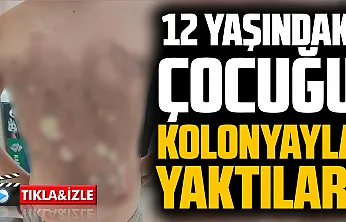 Arnavutköy'de akran zorbalığı: 12 yaşındaki çocuğun sırtını kolonya ile yaktılar