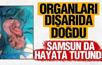 Organları dışarıda doğan Mahmut Talha bebek, Samsun'da hayata tutundu