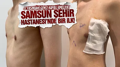 Samsun Şehir Hastanesi'nde bir ilk! 17 yaşındaki gencin göğüs kafesi kapalı ameliyatla düzeltildi