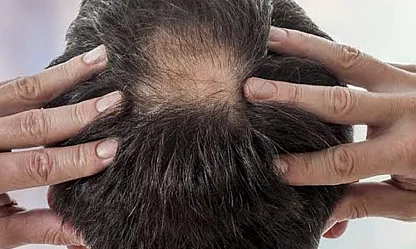 Saç Alarm Veriyor! Uzmanlardan Kritik Uyarı