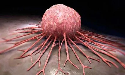 Türkiye'de en yaygın görülen kanser türleri neler?