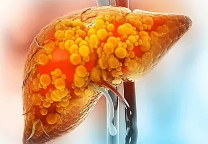 Kan tahlili normal çıksa bile dikkat: Karaciğer yağlanması siroza sürüklüyor