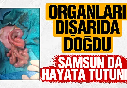 Organları dışarıda doğan Mahmut Talha bebek, Samsun'da hayata tutundu