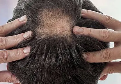 Saç Alarm Veriyor! Uzmanlardan Kritik Uyarı