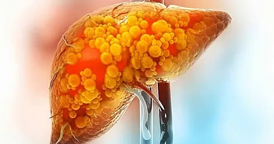 Kan tahlili normal çıksa bile dikkat: Karaciğer yağlanması siroza sürüklüyor