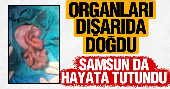 Organları dışarıda doğan Mahmut Talha bebek, Samsun'da hayata tutundu