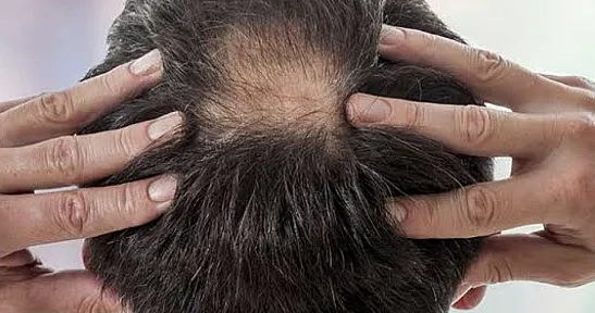 Saç Alarm Veriyor! Uzmanlardan Kritik Uyarı