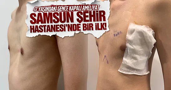 Samsun Şehir Hastanesi'nde bir ilk! 17 yaşındaki gencin göğüs kafesi kapalı ameliyatla düzeltildi