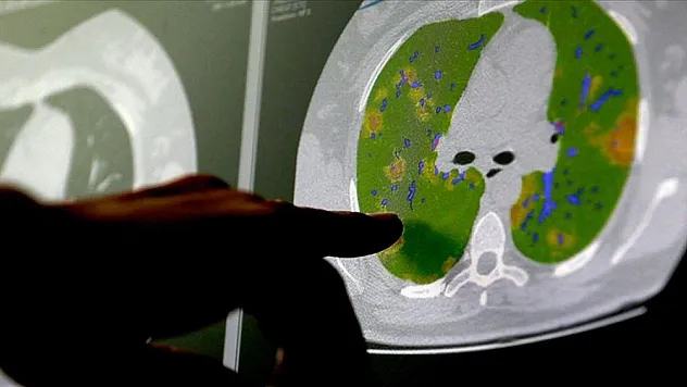 Kovid-19 virüsünün beyin hücreleriyle birleşebildiği kanıtlandı