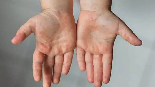 Çocuk sağlığı uzmanı uyardı: 'Kızamık aşı ile önlenebilen ciddi bir hastalık'