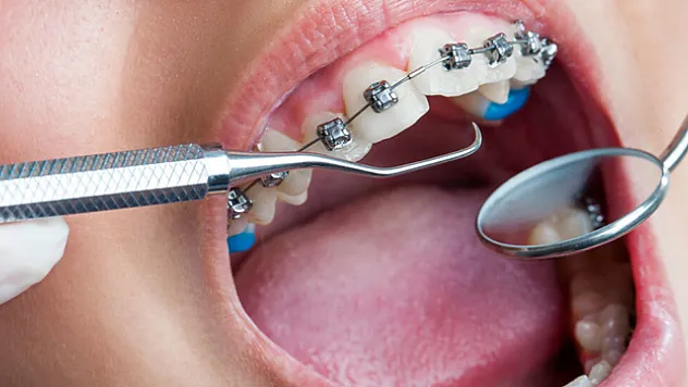 Ortodontik sorunlar öz güven problemlerine yol açabiliyor