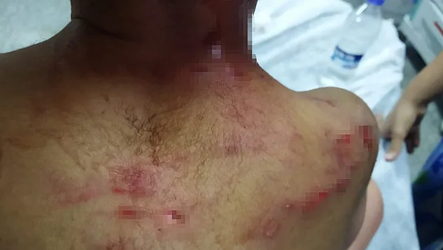 Köpeğin saldırısına uğrayan çocuğun kafasında derin yaralar oluştu