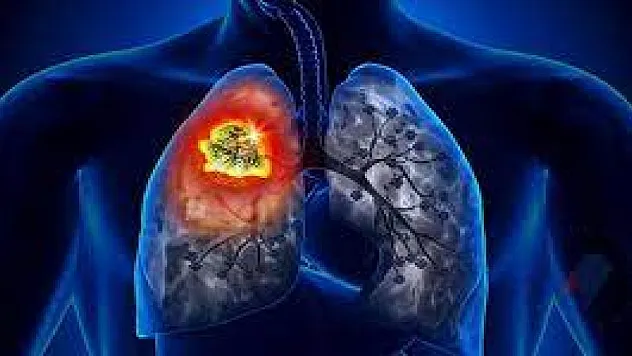 Dünyada en çok ölüme kanser akciğer kanseri