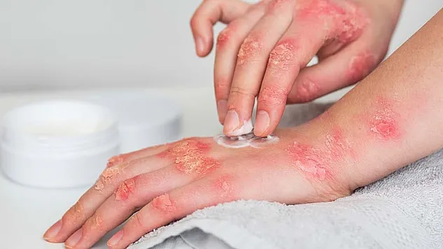 'Poliklinik hastalarının yüzde 30'unu uyuz vakaları oluşturuyor'