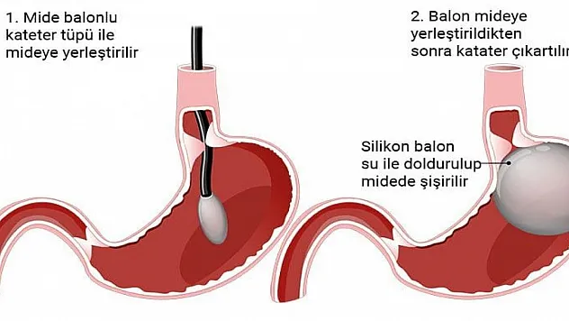 Mide balonu ile zayıflayın