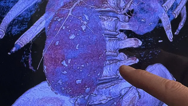 Aort damarı 11 santimetreye çıkıp patladı