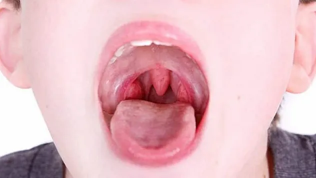 Geniz eti enfeksiyonu tekrarlar mı?