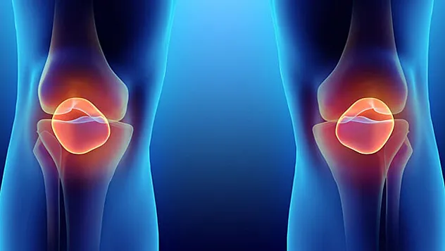 Diz kireçlenmesi tedavi altına alınabilir