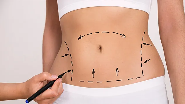 'Kilo kaybına bağlı sarkmalar, karın estetiğiyle önlenebilir'