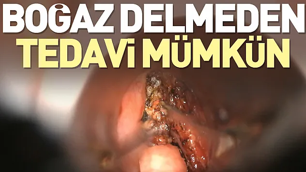 Boğaz delmeden tedavi mümkün