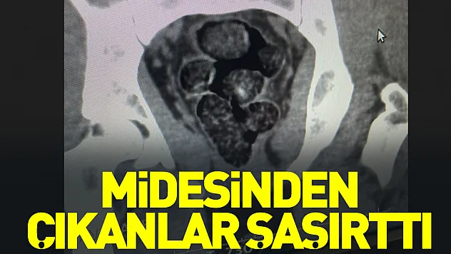 Midesinden çıkanlar şaşırttı