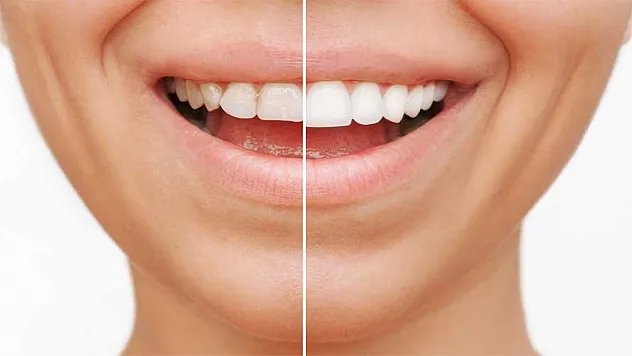 Bonding İşlemi Nedir?