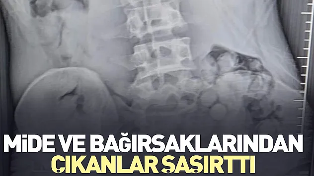 Mide ve bağırsaklarından çıkanlar şaşırttı