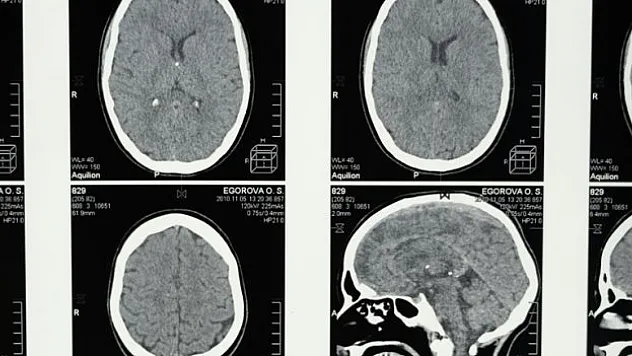 Alzheimer belirtisi olabilir