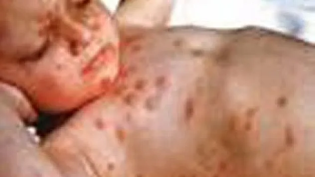 AİLELERE KIZAMIK UYARISI 