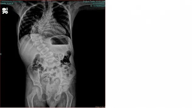 KARADENİZ'DE YENİ BİR AMELİYAT TEKNİĞİ UYGULANDI 